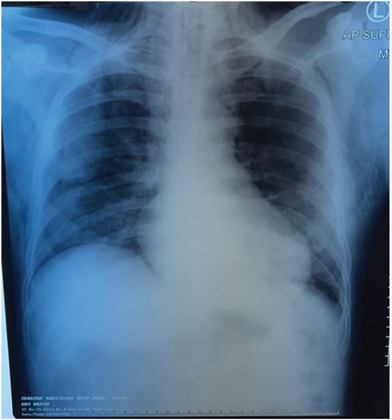 Subcutaneous Emphysema