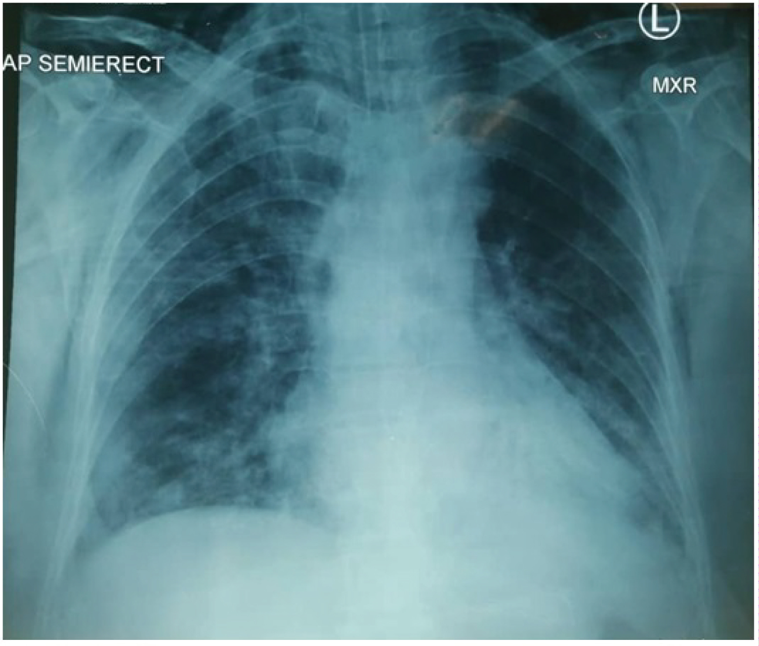 Subcutaneous Emphysema in COVID19 Managed with Surgical Tracheostomy A Case Series