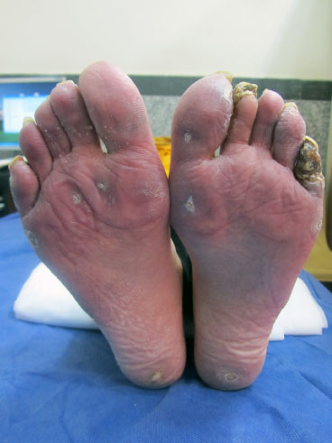 Feet Problems And Scleroderma