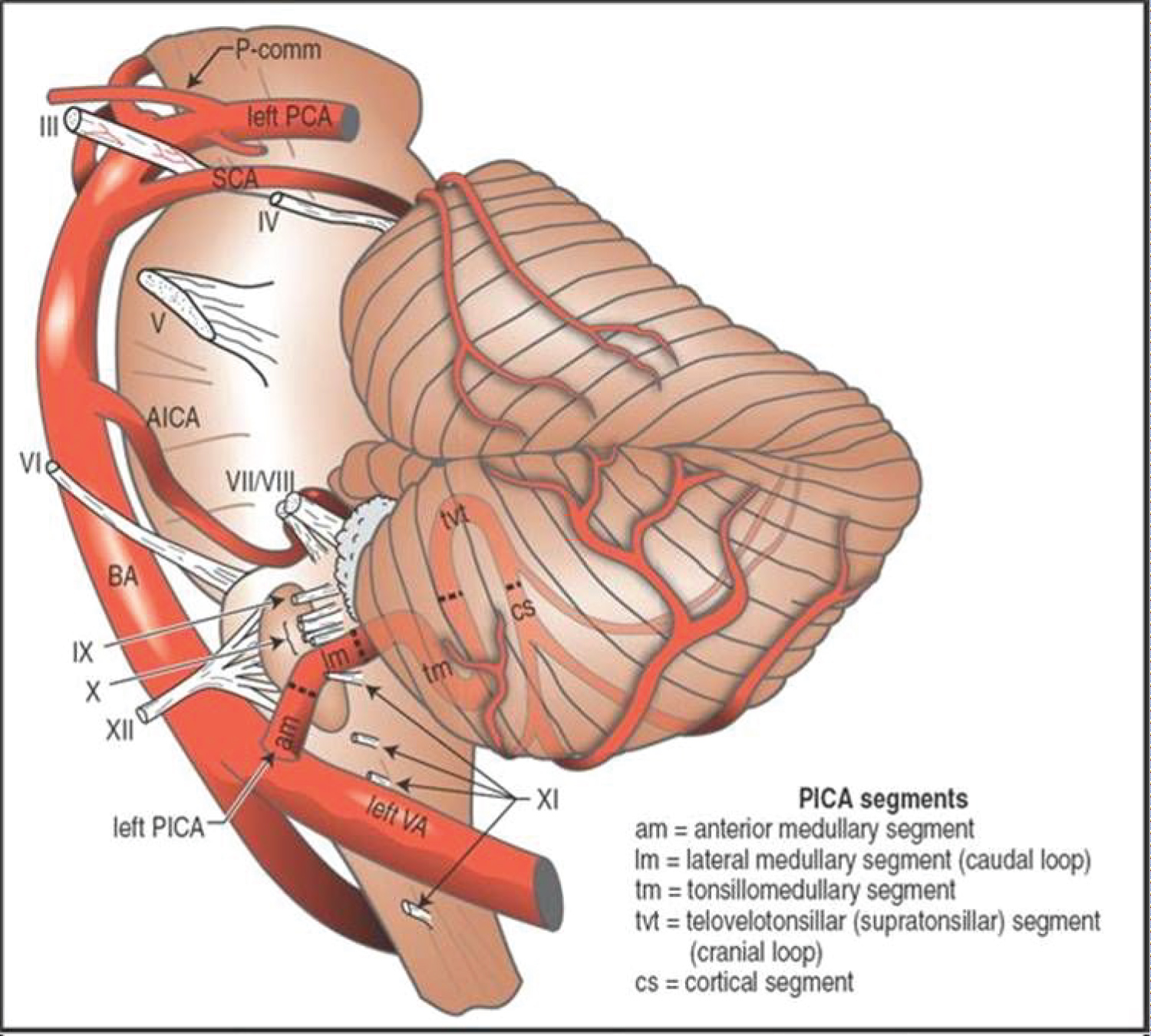 Posterior Inferior Cerebellar Artery Aneurysm