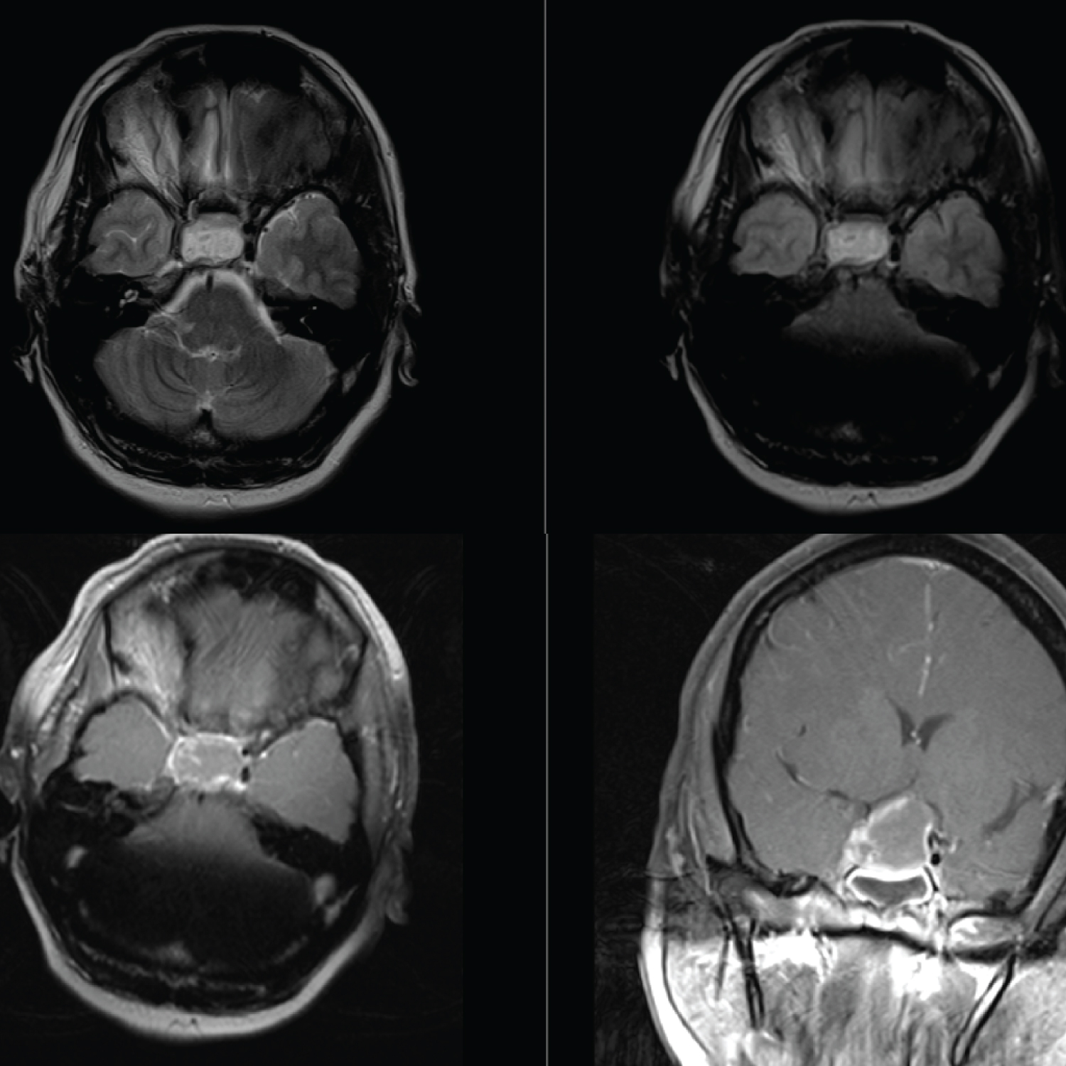 Cerebral Infarction from Compression of the Internal Carotid Artery - A ...