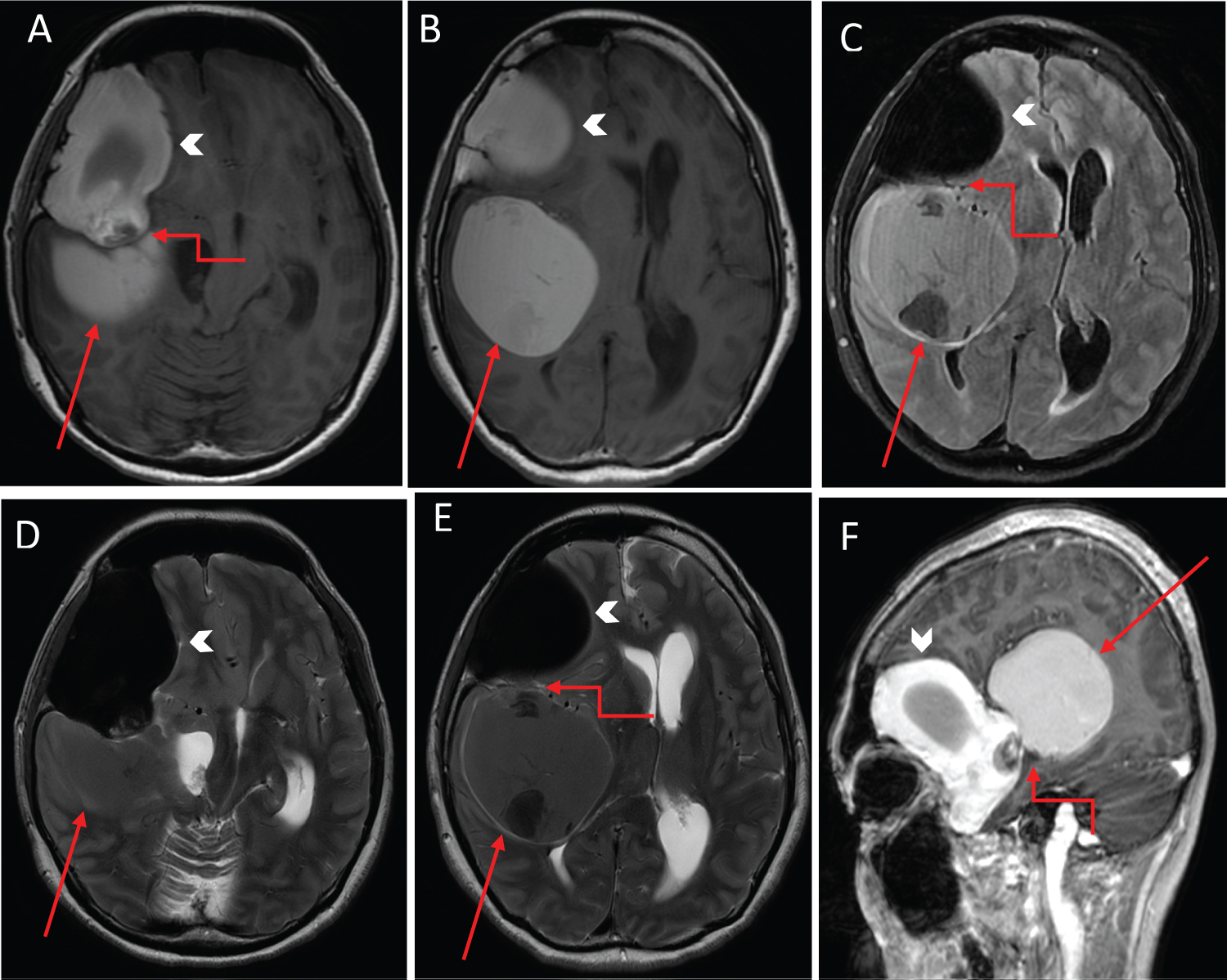 Simultaneous Discrete Intradiploic And Intracerebral Atypical