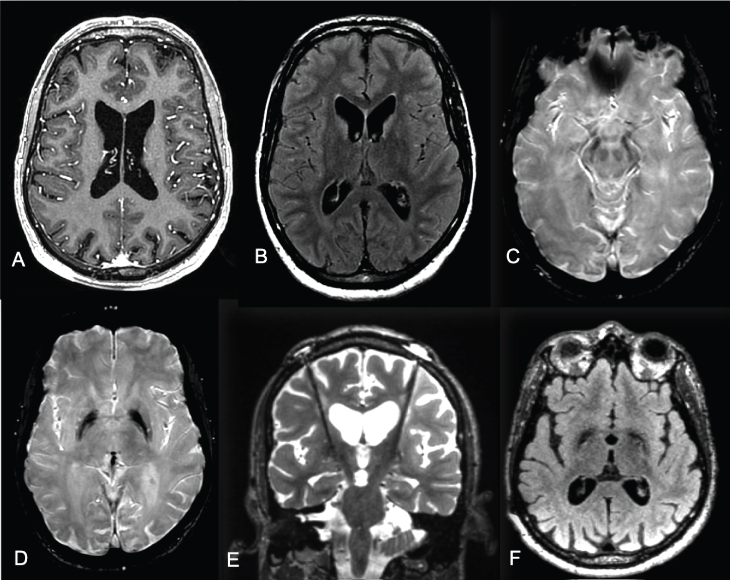 Bilateral Globus Pallidus Internus Deep Brain Stimulation in ...