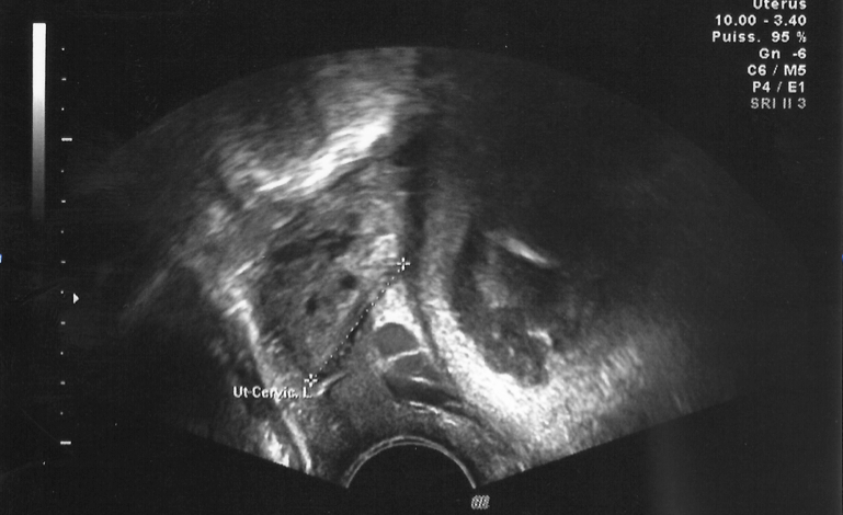 Figure 1: A trans-vaginal ultrasonography showing a normally situated, intrauterine pregnancy with anterior placenta.