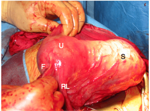 Figure 2: A side view showing the uterine body (U), the interstitial segment of
the fallopian tube (F), and the right round ligament. Anteriorly and to the left
is the empty gestational sac (GS), covered by the peritoneum: photo taken
after foetus and placenta extraction. The uterus is displaced 90 degrees by
the gestational sac.
