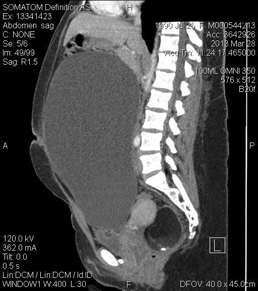 Figure 1: Computed tomography scan of large right ovarian cyst.