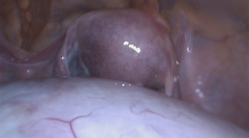 Figure 2: Laparoscopic view of large right ovarian cyst and normal uterus.