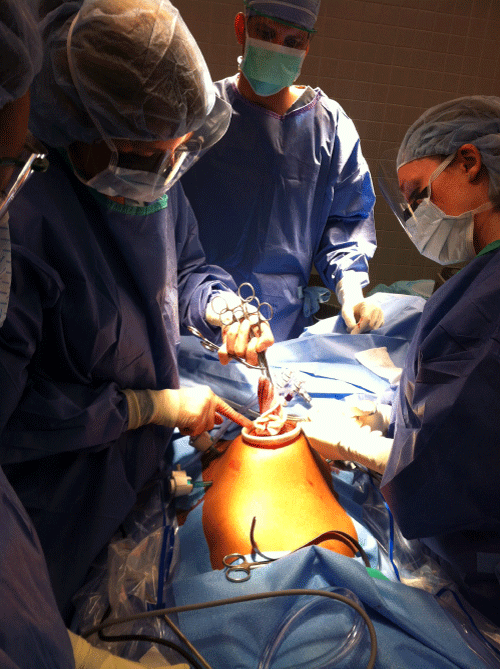 Figure 3: Morcellation of large right ovarian cyst through a 2cm minilaparotomy
using a self retaining retractor.