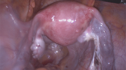 Figure 4: Post-procedure view of normal uterus and preserved right and left
ovaries and fallopian tubes.