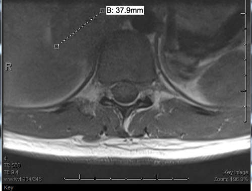 Figure 1: T1 Weighted Thoracic MRI obtained at 32 weeks gestation.