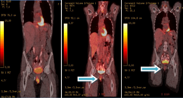 Figure 2: Regression of the vulvar lesion of patient # 1 after three cycles
and complete disappearance of the lesion after 6 cycles of chemotherapy.