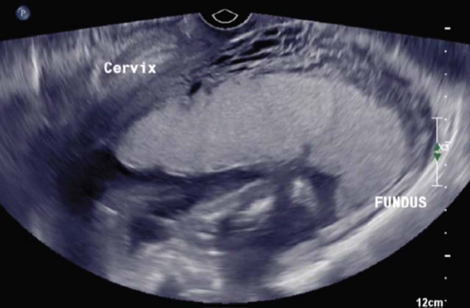 Acute urinary retention due to a nonincarcerated retroverted gravid uterus
