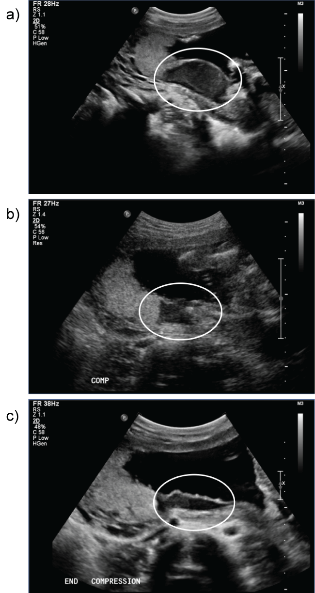 Breus Mole: A Placental Anomaly in a Patient Undergoing a Dilation and ...
