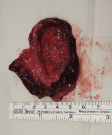 Decidual Cast (TW: uterine lining) : r/endometriosis