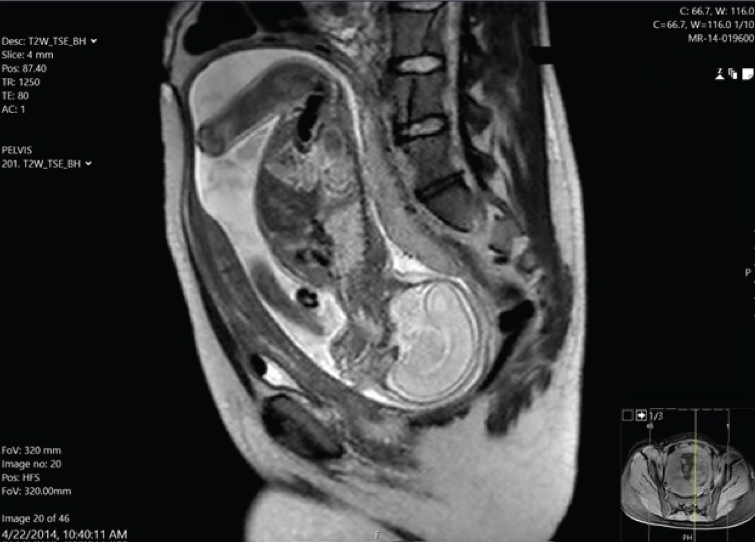 Figure 1 from Acute Urinary Retention Due to an Incarcerated