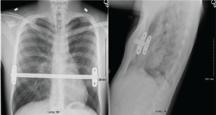 Chest radiography after the Nuss procedure. Four types of bar position;